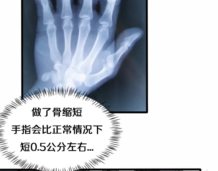 第58话 断指再植74