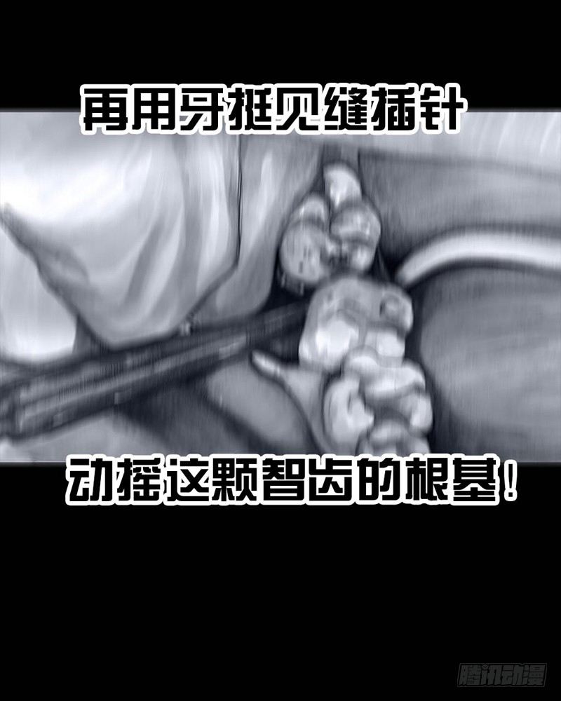番外：拔牙41